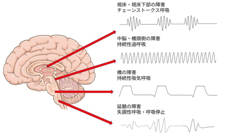 特発性頭蓋内圧亢進症患者の今後の見通しはどうなりますか?