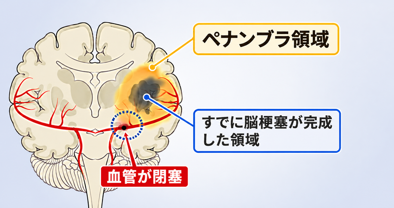 脳梗塞の虚血コアとペナンブラ領域を示す脳の模式図。血管が閉塞した部位と、血流が戻れば回復できる領域を図解