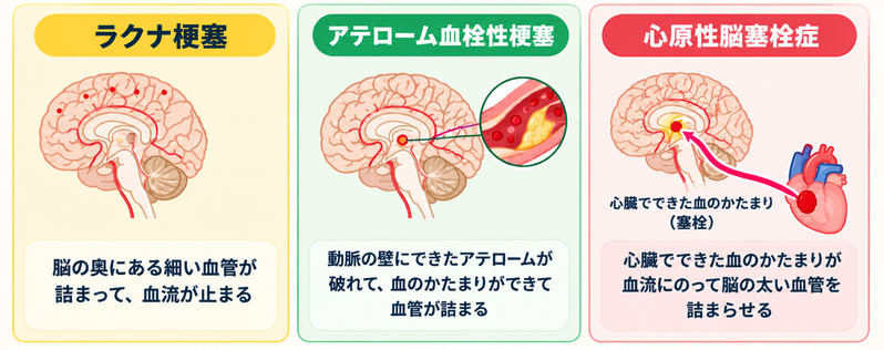 ラクナ梗塞・アテローム血栓性脳梗塞・心原性脳塞栓症という脳梗塞3つの病型の違いを比較したイラスト